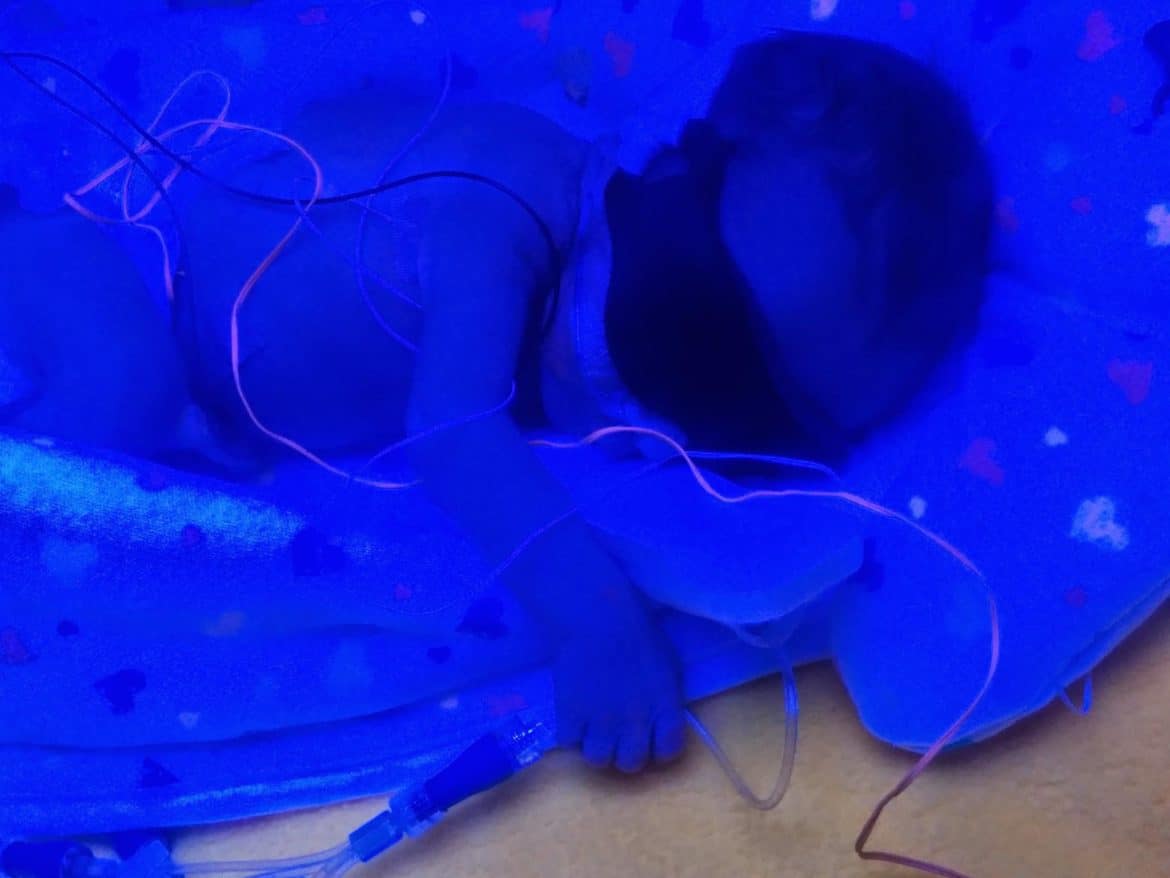 baby being treated for jaundice with blue light