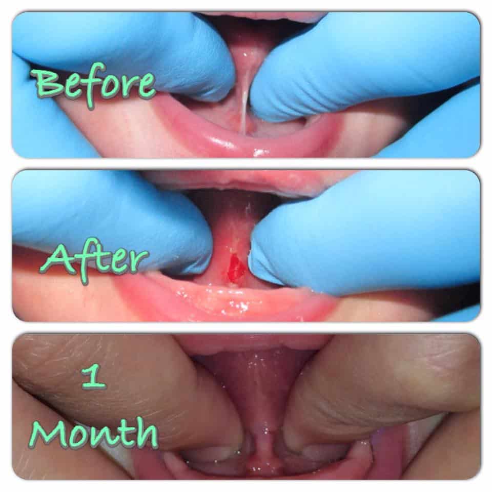 before and after tongue tie treatment example