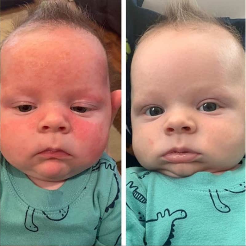 Example of baby before and after using Tubby Todd All Over Ointment