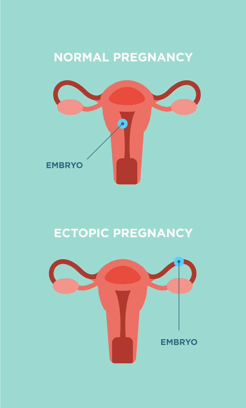 ectopic pregnancy diagram