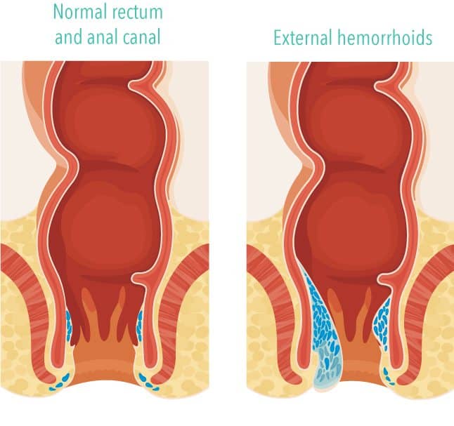 diagram of what hemorrhoids look like compared to a normal rectumdiagram of what hemorrhoids look like compared to a normal rectum
