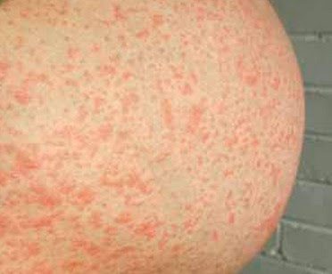Pruritic Urticarial Papules and Plaques of Pregnancy.” PUPPPUPPs rash during pregnancy