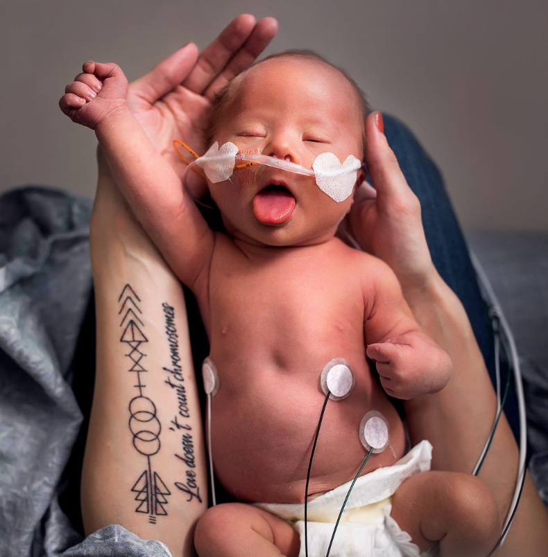 Color photo of baby with supplemental oxygen, NG tube, and several sensors on their stomach sleeps in mom's arms. Tattoo on mom's arm reads: "Love doesn't count chromosomes"